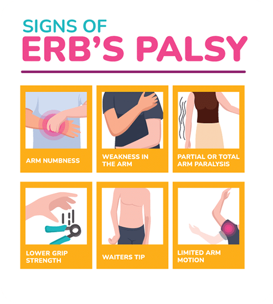 Signs of erb's palsy infographic